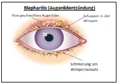 Blepharitis (Augenlidentzndung) Trkei Preis 2026 | Prof. Dr. Gkhan  GLKILIK